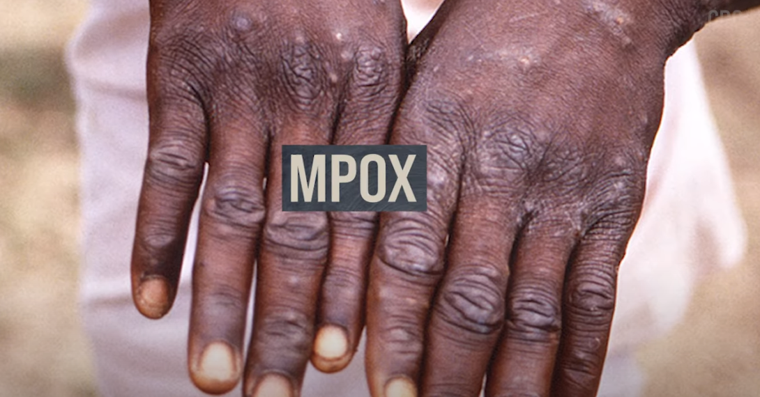 Know About Mpox